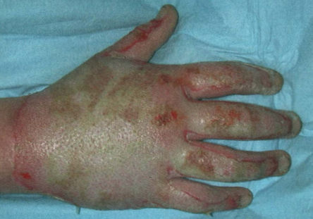 Fiziopatologia leziunilor din arsură | Educato