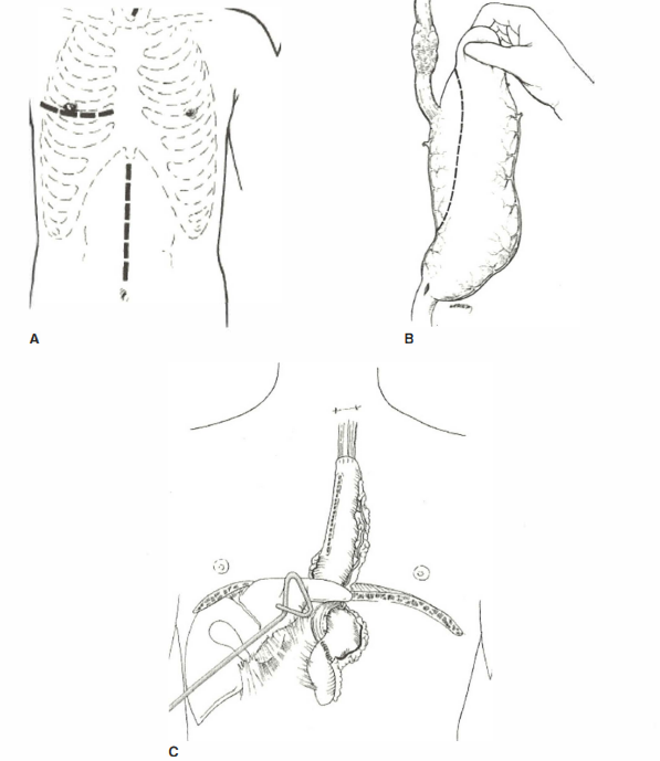 Carcinomul esofagian | Educato